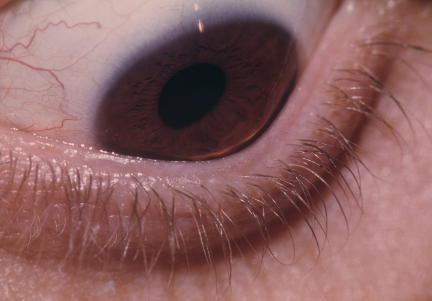 Keratoconus 2 Hereditary Ocular Diseases